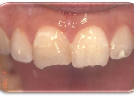 Metsger Patel Dental | Dentures, Implant Restorations and Preventative Program