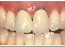 Metsger Patel Dental | Digital Impressions, Implant Restorations and Pediatric Dentistry