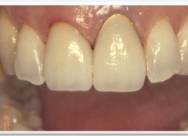 Metsger Patel Dental | Periodontal Treatment, Teeth Whitening and Inlays amp Onlays