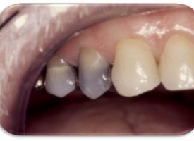 Metsger Patel Dental | Inlays amp Onlays, Intraoral Camera and Digital Impressions