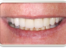 Metsger Patel Dental | Night Guards, Oral Exams and Digital Radiography