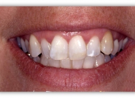 Metsger Patel Dental | Extractions, Dental Sealants and Dentures