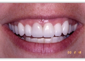 Metsger Patel Dental | TMJ Disorders, Implant Dentistry and Night Guards