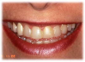 Metsger Patel Dental | All-on-6 reg , Implant Dentistry and Dental Cleanings