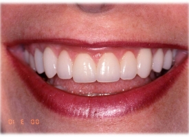 Metsger Patel Dental | Oral Cancer Screening, Preventative Program and Dental Cleanings