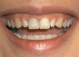 Metsger Patel Dental | Pediatric Dentistry, Dental Fillings and Fluoride Treatment