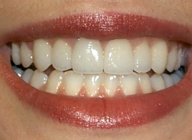 Metsger Patel Dental | Inlays amp Onlays, Ceramic Crowns and Root Canals