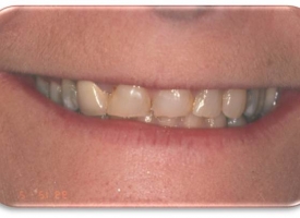 Metsger Patel Dental | All-on-6&reg;, Inlays & Onlays and Ceramic Crowns