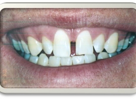 Metsger Patel Dental | All-on-6&reg;, Ceramic Crowns and Digital Impressions