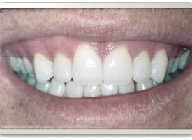 Metsger Patel Dental | Implant Dentistry, Crowns and Dental Bridges